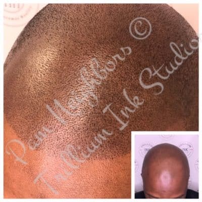 hairline treatment for black men