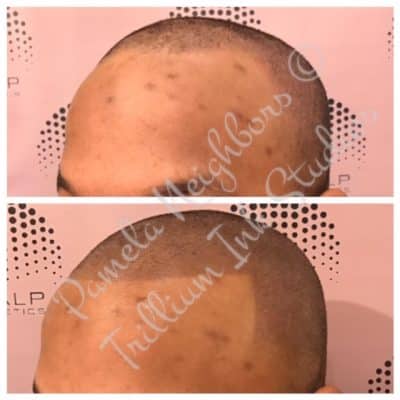 scalp micropigmentation men