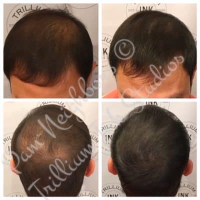 add density to hairline solution