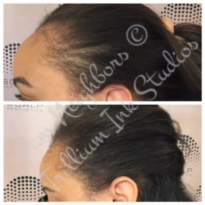 before and after traction alopecia smp