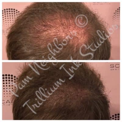 man bald crown before and after smp
