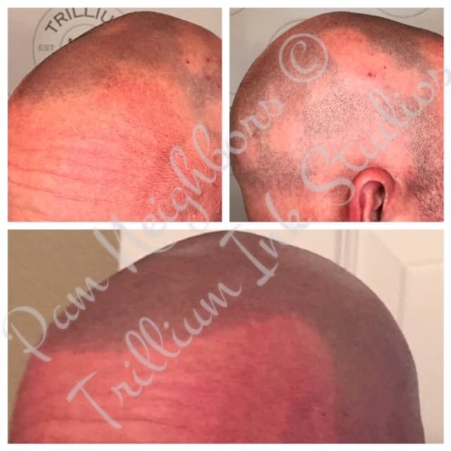 alopecia areata treatment