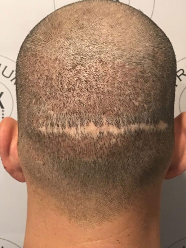 big hair transplant scar