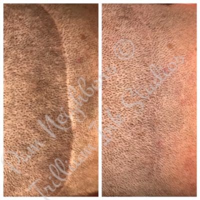 scar coverup treatment for man