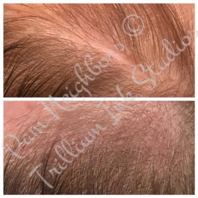 lady after scalp micropigmentation