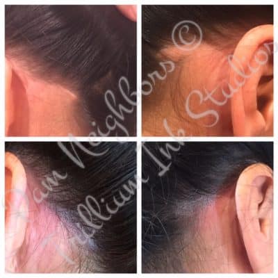thin hair behind ears before and after treatment