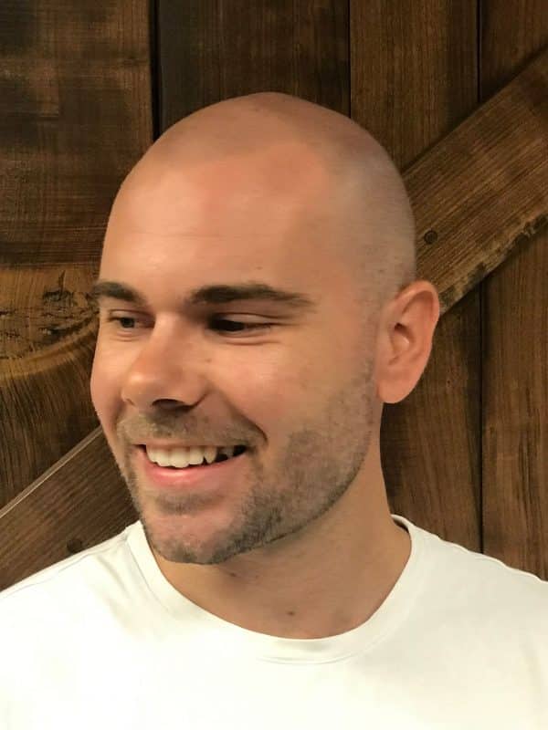 alopecia treatment for men