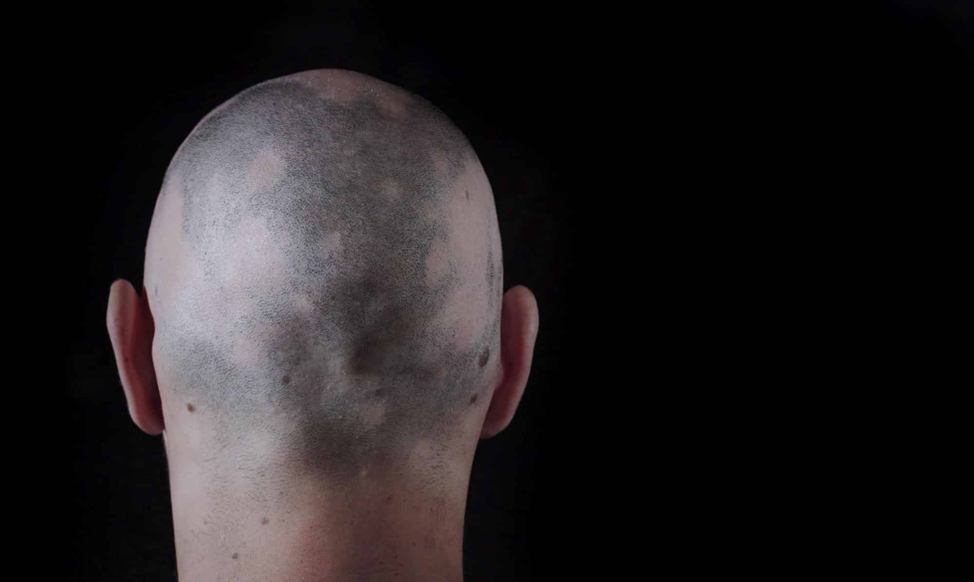 scalp micropigmentation for alopecia