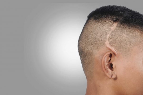 scalp micropigmentation for scars