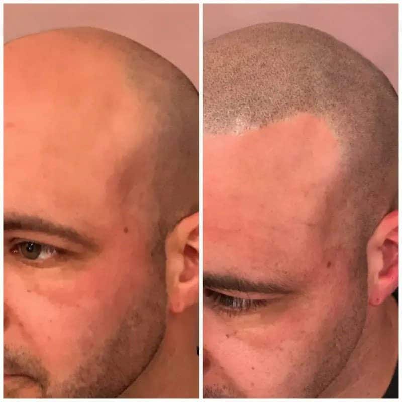 male hairline before and after scalp micropigmentation