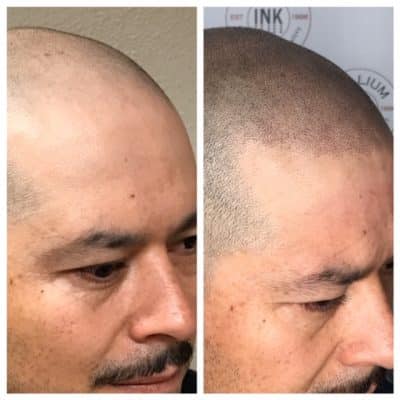 man after smp hair loss treatment