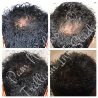 man with thin crown before and after