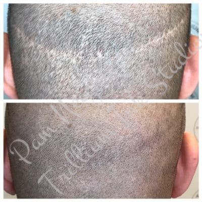 male head scar before and after
