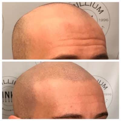 natural scalp micropigmentation for man