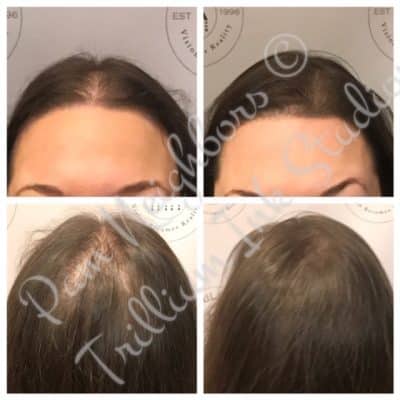thinning hairline on woman before and after