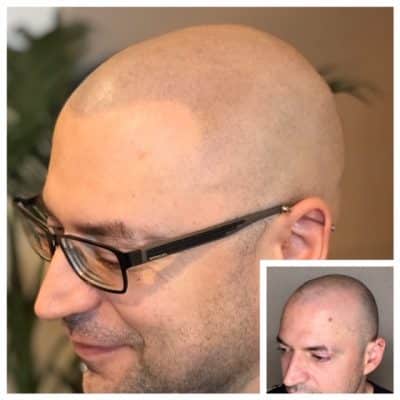 man before and after scalp micropigmentation