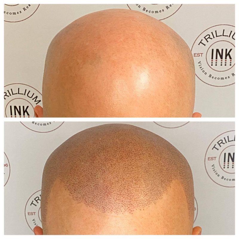 Pacific Northwest Scalp Micropigmentation